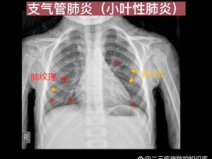 我想要看胸片曝光,我想看胸片曝光，请问这是怎么回事？