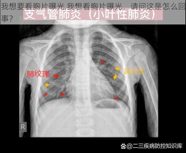 我想要看胸片曝光,我想看胸片曝光，请问这是怎么回事？