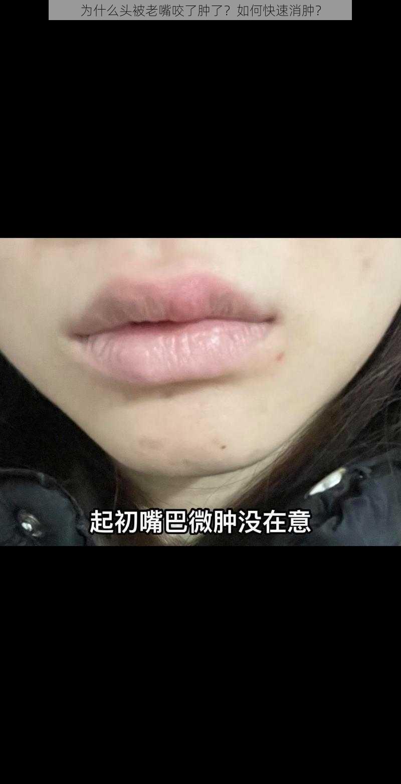 为什么头被老嘴咬了肿了？如何快速消肿？